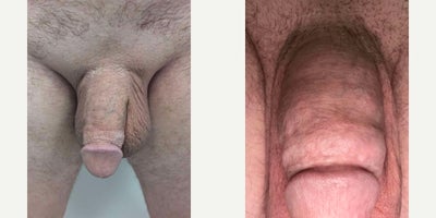 Case 11567 - Man treated with Penis Fillers, Penis Enlargement