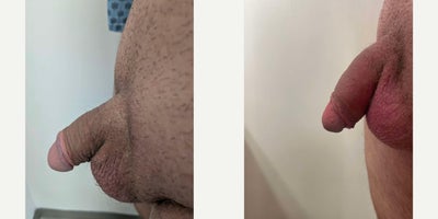 Case 11575 - Man treated with Penis Fillers, Penis Enlargement