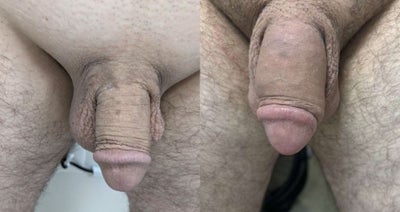 Case 11576 - Man treated with Penis Fillers, Penis Enlargement