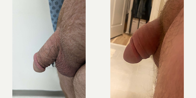 Case 11582 - Man treated with Penis Enlargement