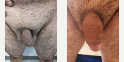 Case 11583 - Man treated with Penis Enlargement