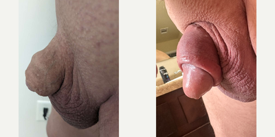 Case 11586 - Man treated with Penis Enlargement