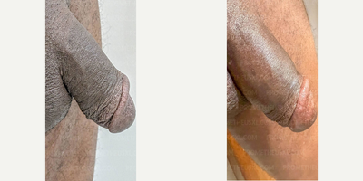 Case 11593 - Man treated with Penis Enlargement, Penis Fillers