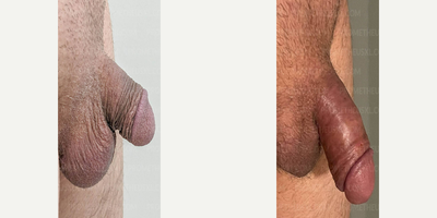 Case 11595 - Man treated with Penis Enlargement, Penis Fillers