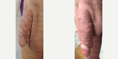 Case 11596 - Man treated with Penis Enlargement, Penis Fillers