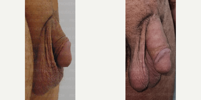 Case 11598 - Man treated with Penis Fillers, Penis Enlargement