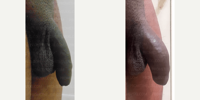 Case 11599 - Man treated with Penis Fillers, Penis Enlargement