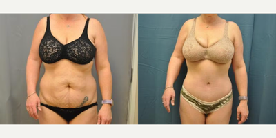 Case 116 - Woman treated with Tummy Tuck