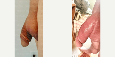 Case 11600 - Man treated with Penis Fillers, Penis Enlargement