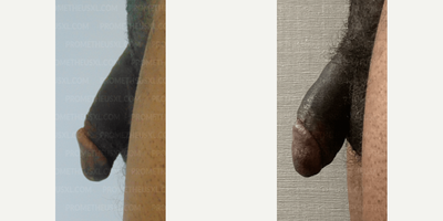 Case 11601 - Man treated with Penis Fillers, Penis Enlargement