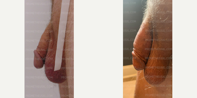 Case 11604 - Man treated with Penis Enlargement, Penis Fillers