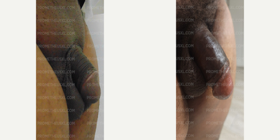 Case 11605 - Man treated with Penis Enlargement, Penis Fillers