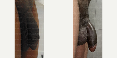 Case 11606 - Man treated with Penis Enlargement, Penis Fillers