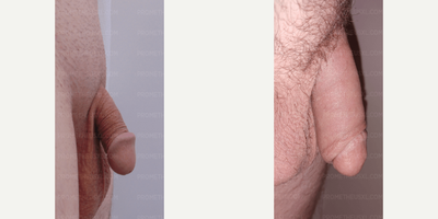 Case 11607 - Penis Enlargement