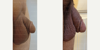 Case 11610 - Penis Enlargement