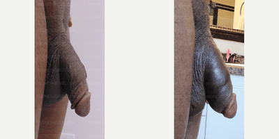 Case 11611 - Penis Enlargement