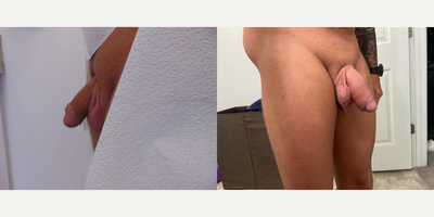 Case 11613 - 35-44 year old man treated with Penis Enlargement