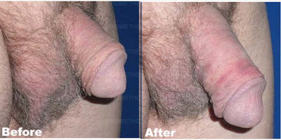 Case 11617 - Man treated with Penis Enlargement