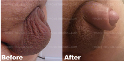 Case 11618 - Man treated with Penis Enlargement