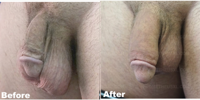 Case 11619 - Man treated with Penis Enlargement