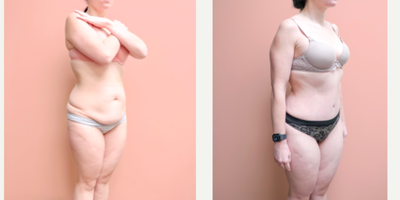 Case 1162 - 35-44 year old woman treated with Tummy Tuck, Liposuction