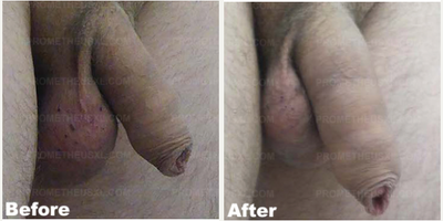 Case 11620 - Man treated with Penis Enlargement