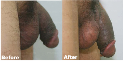 Case 11621 - Man treated with Penis Enlargement