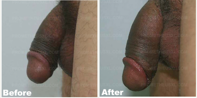 Case 11622 - Man treated with Penis Enlargement