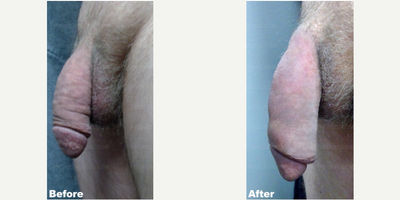 Case 11623 - Man treated with Penis Enlargement