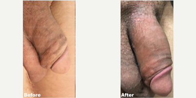 Case 11624 - Man treated with Penis Enlargement