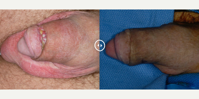 Case 11626 - Man treated with Penis Enlargement