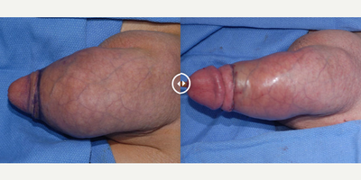 Case 11627 - Man treated with Penis Enlargement
