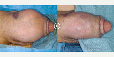 Case 11628 - Man treated with Penis Enlargement