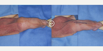 Case 11629 - Man treated with Penis Enlargement