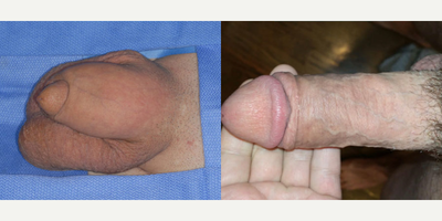 Case 11630 - Man treated with Penis Enlargement