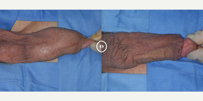 Case 11631 - Man treated with Penis Enlargement