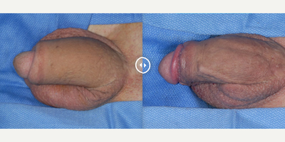 Case 11632 - Man treated with Penis Enlargement