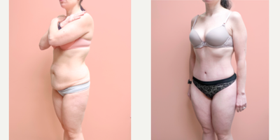 Case 1164 - 35-44 year old woman treated with Tummy Tuck, Liposuction