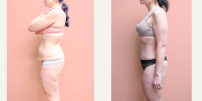 Case 1165 - 35-44 year old woman treated with Tummy Tuck, Liposuction