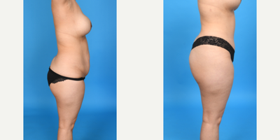 Case 1166 - 35-44 year old woman treated with Abdominal Etching, Diastasis Recti Repair, Drainless Tummy Tuck, Liposculpture, Liposuction, M