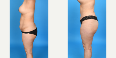 Case 1167 - 35-44 year old woman treated with Abdominal Etching, Diastasis Recti Repair, Drainless Tummy Tuck, Liposculpture, Liposuction, M