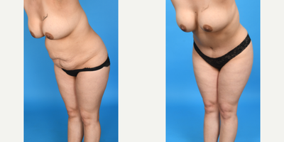 Case 1169 - 35-44 year old woman treated with Abdominal Etching, Diastasis Recti Repair, Drainless Tummy Tuck, Liposculpture, Liposuction, M