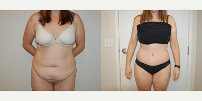 Case 117 - Woman treated with Tummy Tuck