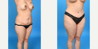 Case 1170 - 35-44 year old woman treated with Abdominal Etching, Diastasis Recti Repair, Drainless Tummy Tuck, Liposculpture, Liposuction, M