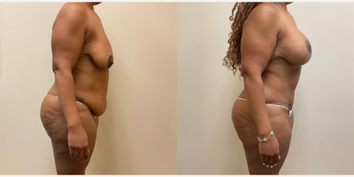 Case 1172 - Woman treated with Breast Lift with Implants, Tummy Tuck