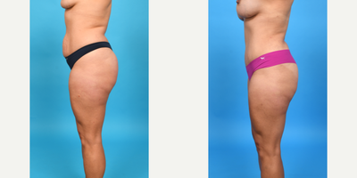 Case 1173 - 25-34 year old woman treated with Abdominal Etching, Diastasis Recti Repair, Drainless Tummy Tuck, Liposuction, Mini Tummy Tuck,