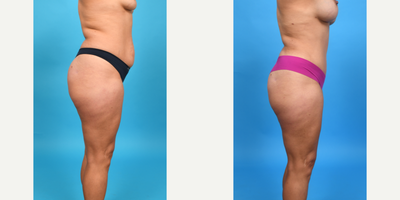 Case 1174 - 25-34 year old woman treated with Abdominal Etching, Diastasis Recti Repair, Drainless Tummy Tuck, Liposuction, Mini Tummy Tuck,