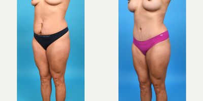 Case 1177 - 25-34 year old woman treated with Abdominal Etching, Diastasis Recti Repair, Drainless Tummy Tuck, Liposuction, Mini Tummy Tuck,