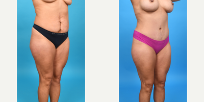 Case 1178 - 25-34 year old woman treated with Abdominal Etching, Diastasis Recti Repair, Drainless Tummy Tuck, Liposuction, Mini Tummy Tuck,