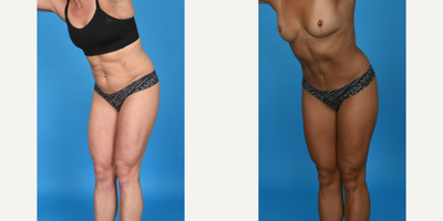 Case 1179 - 35-44 year old woman treated with Abdominal Etching, BodyTite, Diastasis Recti Repair, Drainless Tummy Tuck, Liposculpture, Lipo